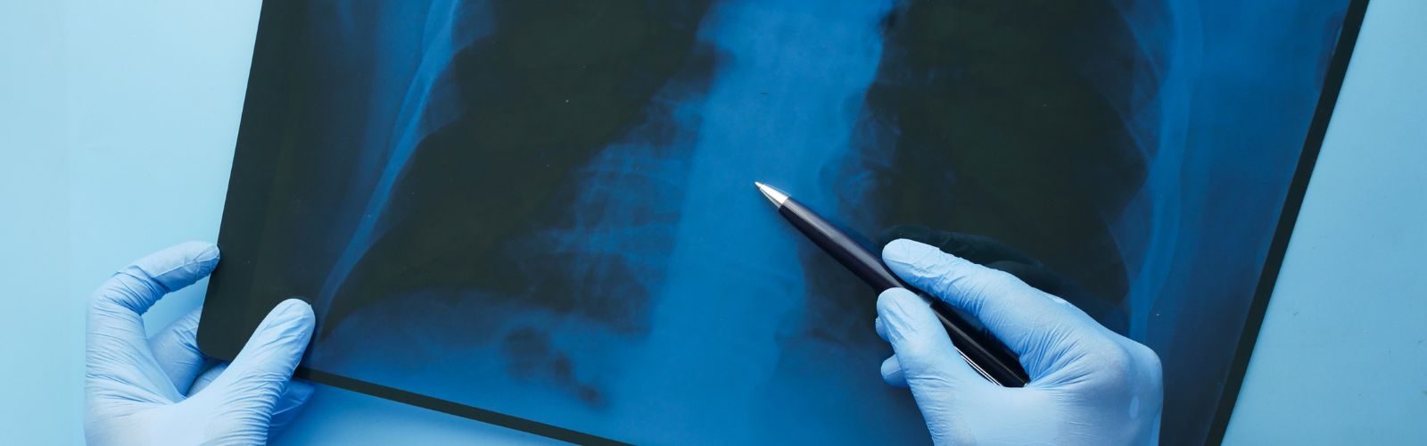 Broncopneumopatia cronica ostruttiva (BPCO): coinvolti non solo i polmoni