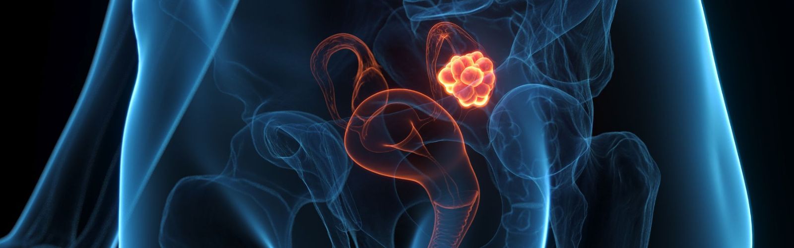 Ricerca, multidisciplinarietà e innovazione. Verona centro di riferimento per il tumore ovarico