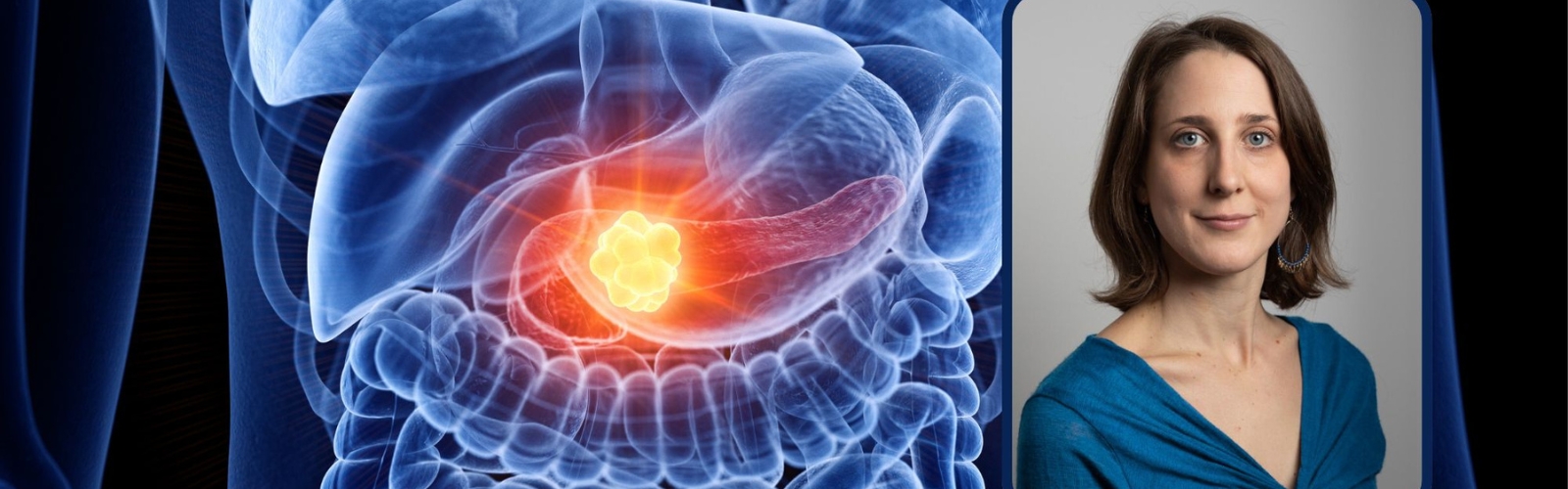 Tumore al pancreas, nuove strategie terapeutiche contro la ferroptosi